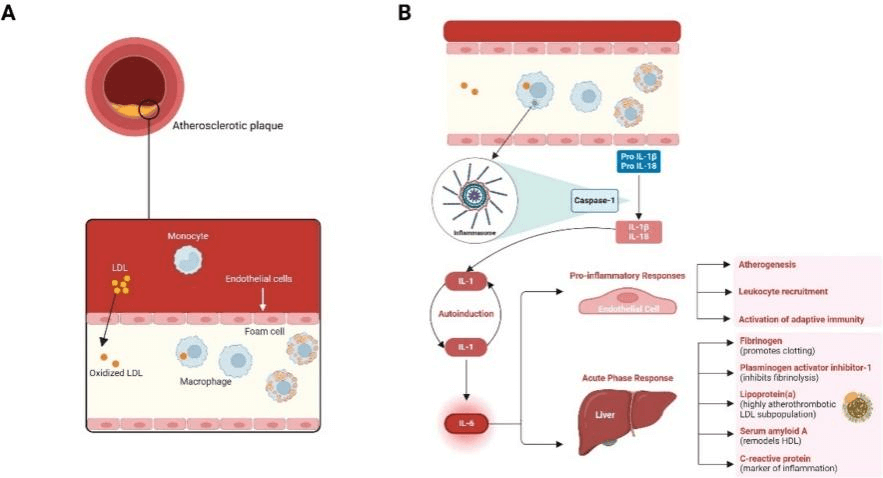 IL-6–mediated inflammation in atherosclerotic cardiovascular disease.