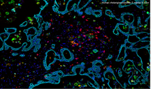5-marker 6-color mIHC staining of human cholangiocarcinoma.
