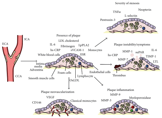 Key immune and molecular biomarkers in carotid atherosclerosis.
