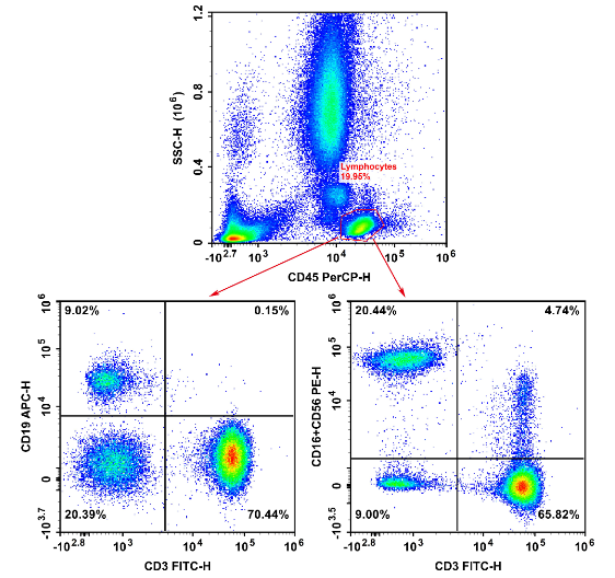 TBNK lymphocyte subset analysis.
