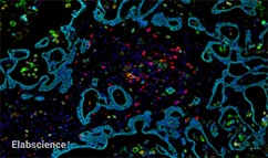 Human Cholangiocarcinoma Tissue