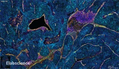 Human Liver Cancer Tissue