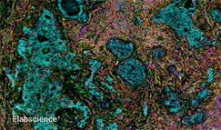 Human Breast Cancer Tissue