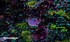 Human Tertiary Lymphoid Structures