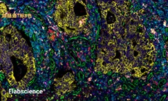 Human Colon Cancer Tissue