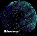 Human Pancreatic Cancer Chip